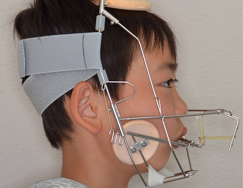 RAMPA（矯正治療）